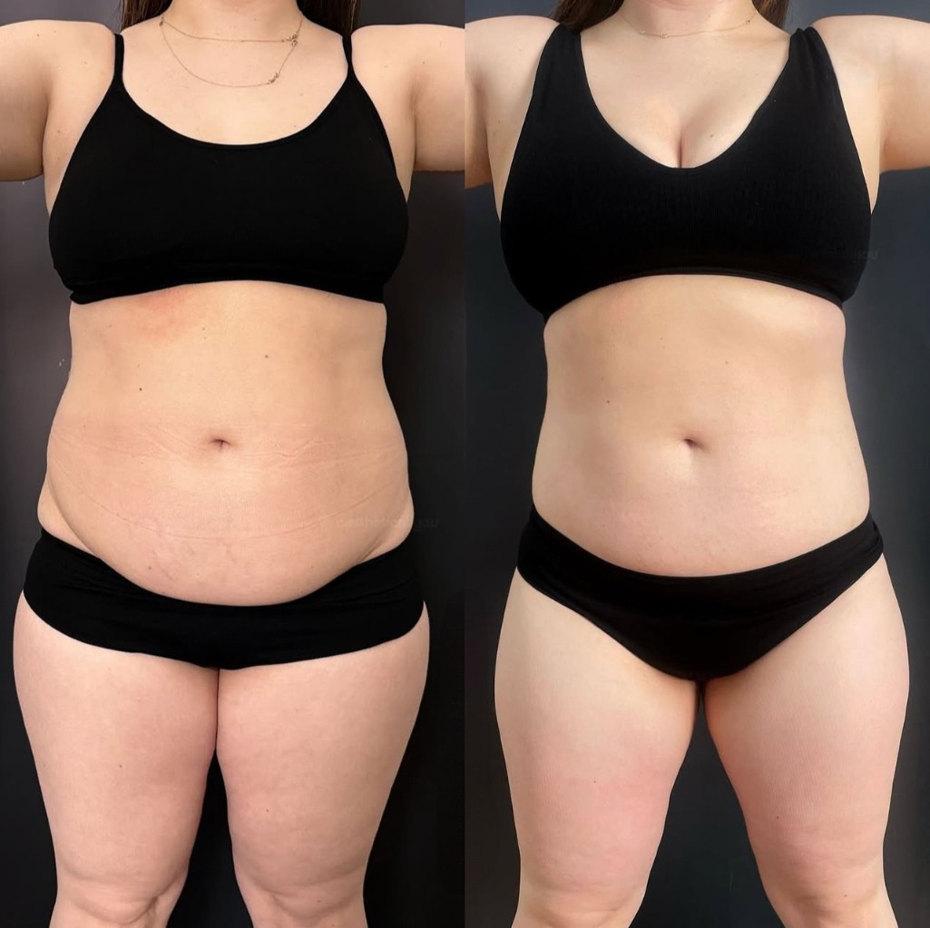 Kaasen Cryo Slimming  Fire and Ice Cryotherapy Longmont, Colorado
